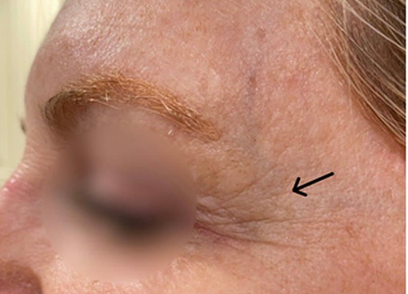 Before V-ST RF Treatment Skin Tightening by Tourmaline Skin Care